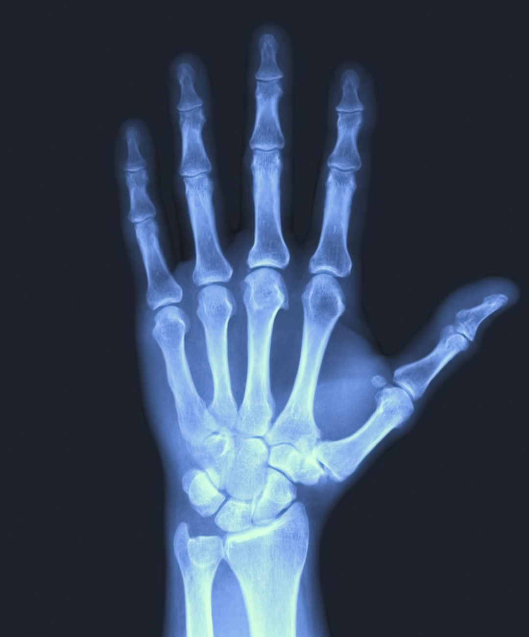 x ray image of child left hand to assess bone age