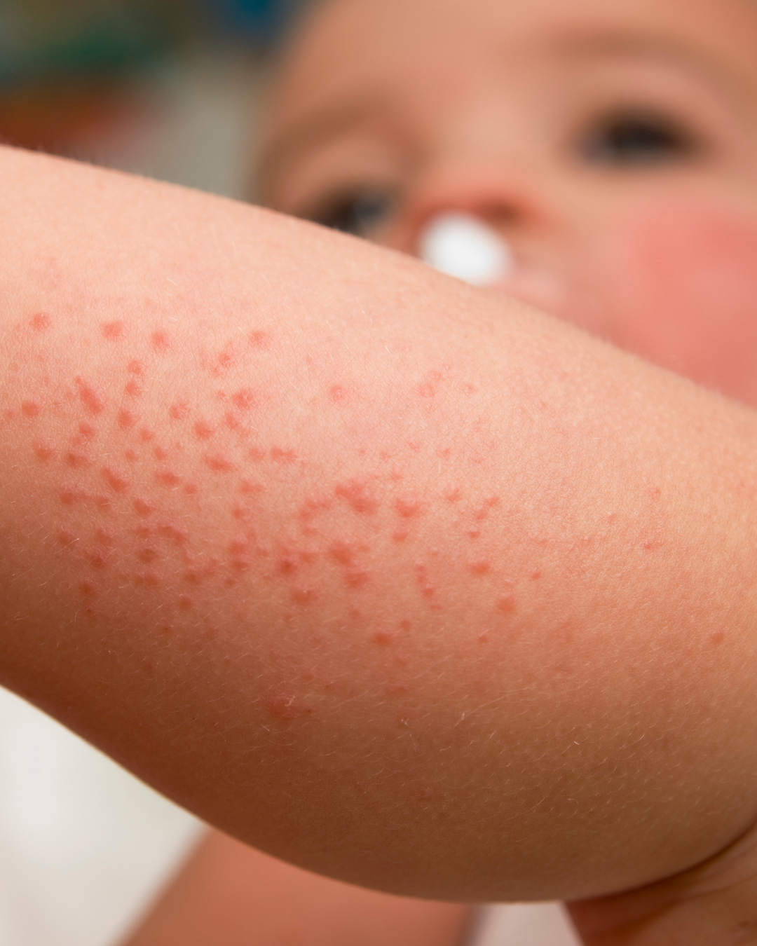 Heat rash in children — THE PEDIATRICIAN MOM