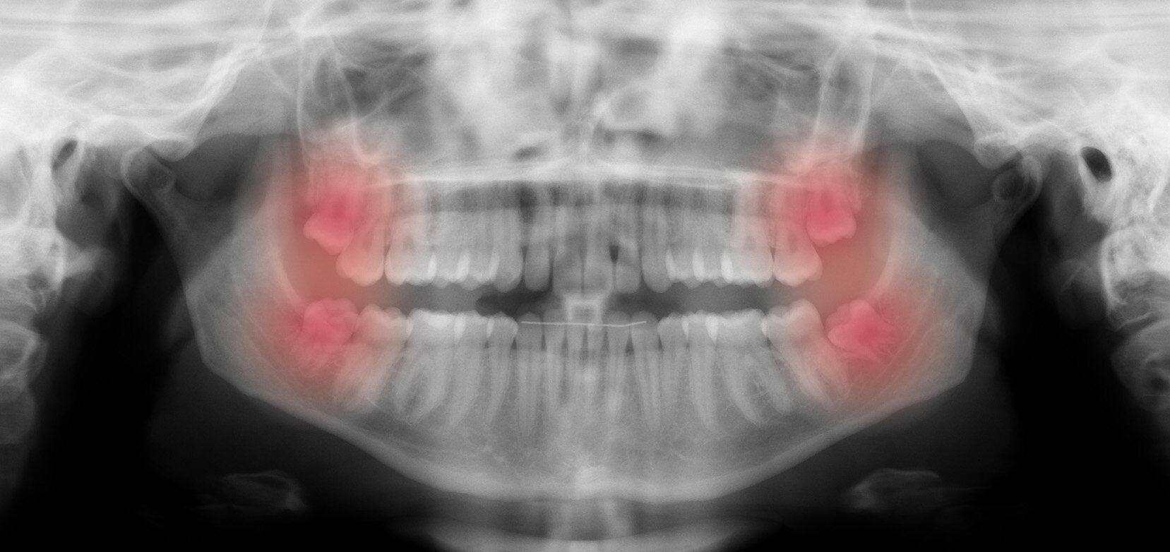 wisdom teeth removal aspendale