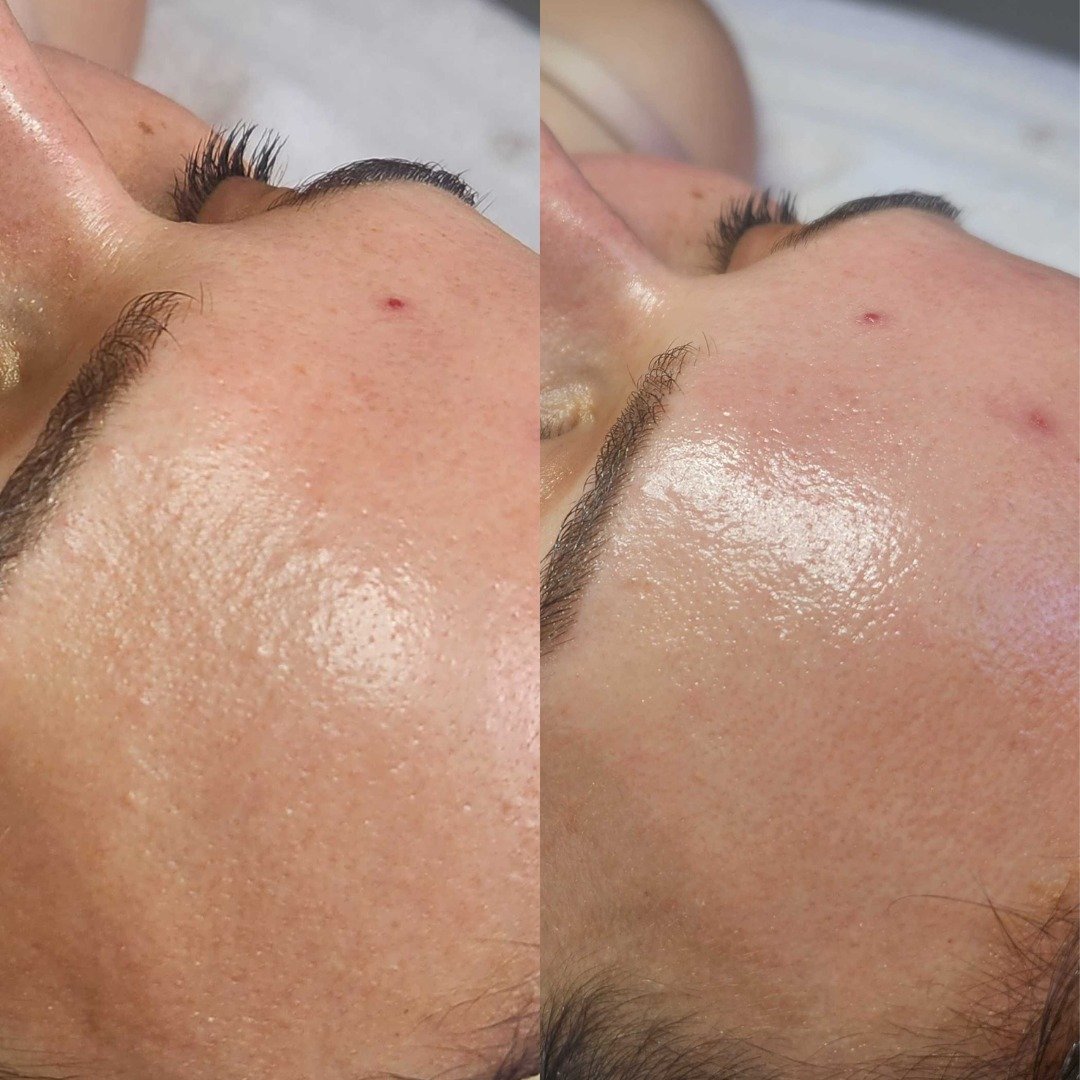 The results from our April Promo are rolling in! This is what zero downtime, fabulous exfolation, and some time with our ABB Skin Therapists look like. Cant wait to have you walking out with reduced texture and a brighter complexion. Dont forget this