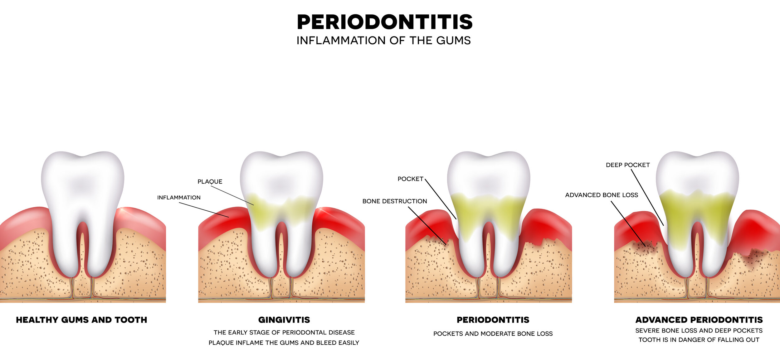 NonSurgical Periodontal Therapy — Dr. Ajay Mehta, DDS