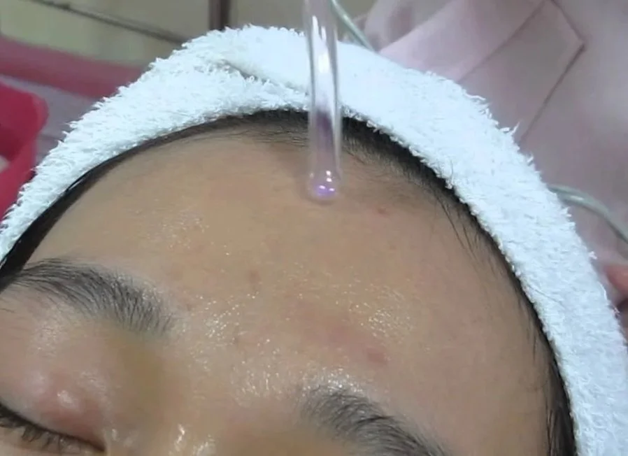Close-up of a person's forehead during the high frequency treatment of an acne facial treatment.