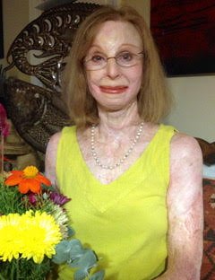 Charlene Pell: What To Do When People Stare