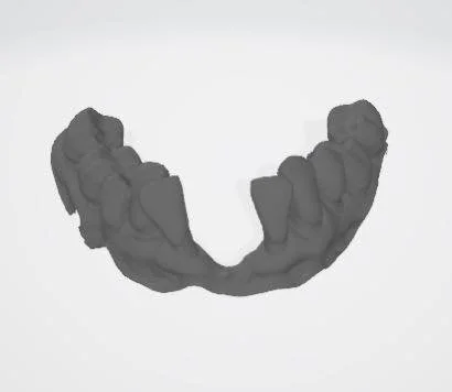 This was a particularly fun case! Our patient wasn’t happy with their removable partial denture and wanted something that stayed in place. Our team really enjoyed flexing their creativity and getting this bridge made in-office! 
#digitaldesign