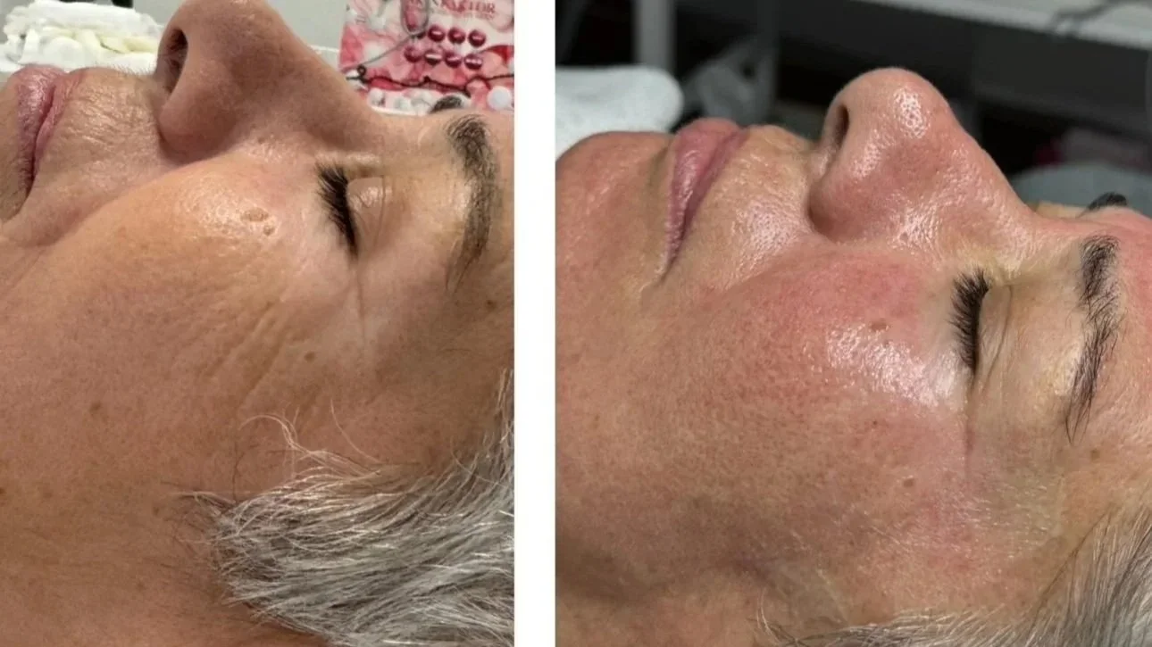 Real skin needling transformation for a mature skin at Beauty By Vicky in Dulwich Hill. Skin needling encourages natural collagen production to improve skin firmness, texture and overall skin quality. 