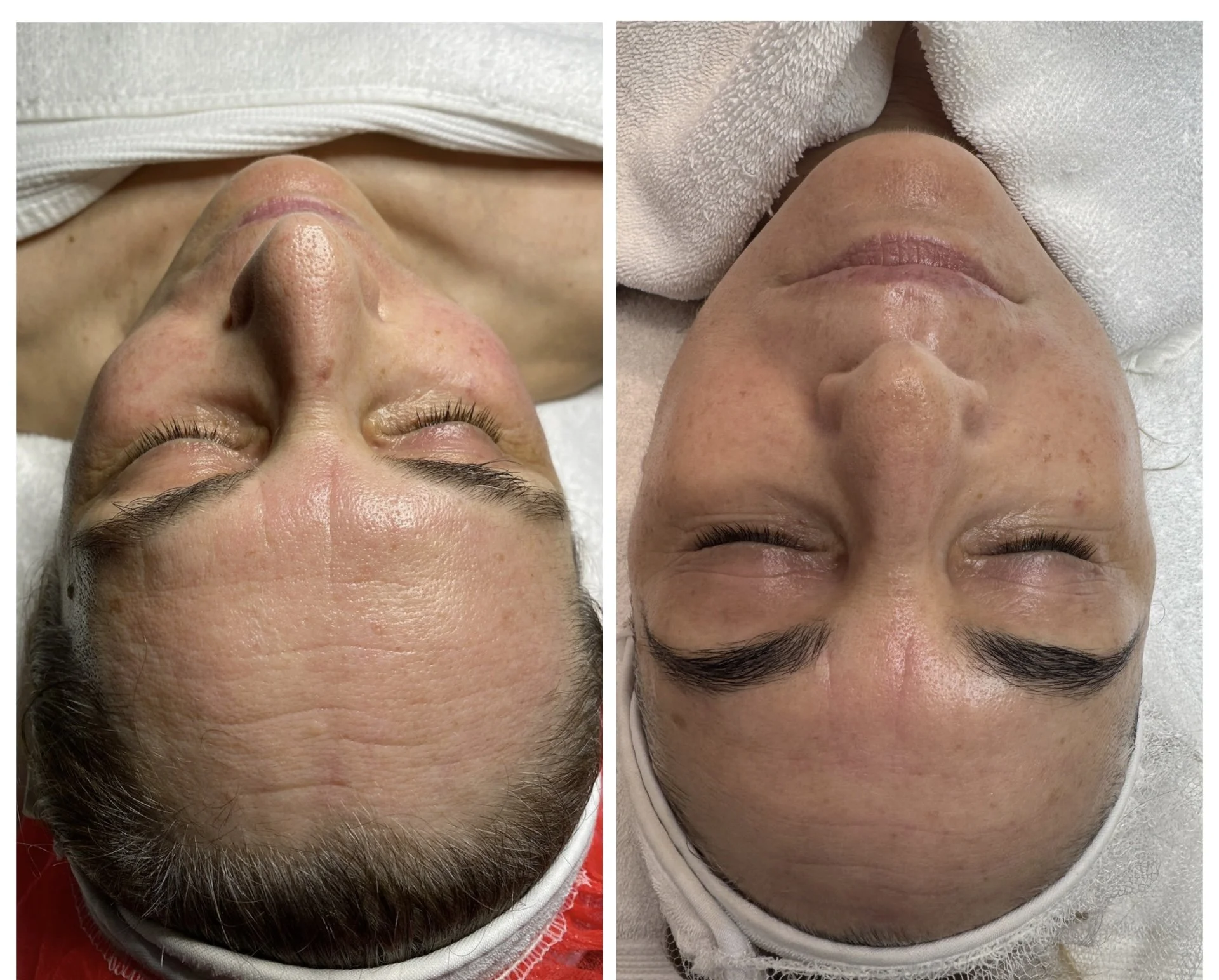 Side-by-side comparison of a person's face before and after a skincare treatment, showing improved skin texture and clarity in the after image.