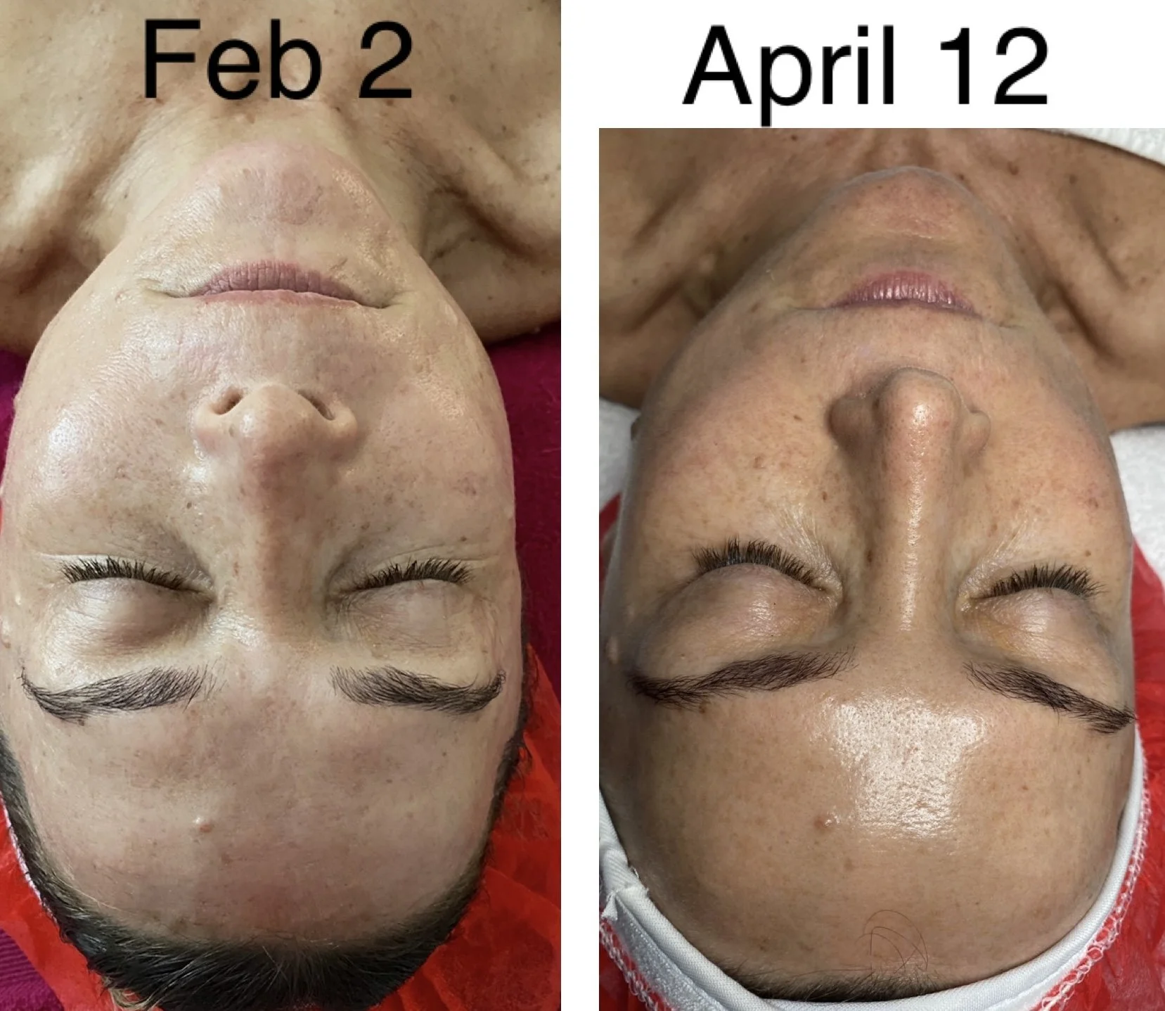 This client achieved smoother, firmer and more radiant skin after a personalised course of six skin needling treatments. Each treatment plan is tailored to the individual's skin concerns and gaols for optimal results. 