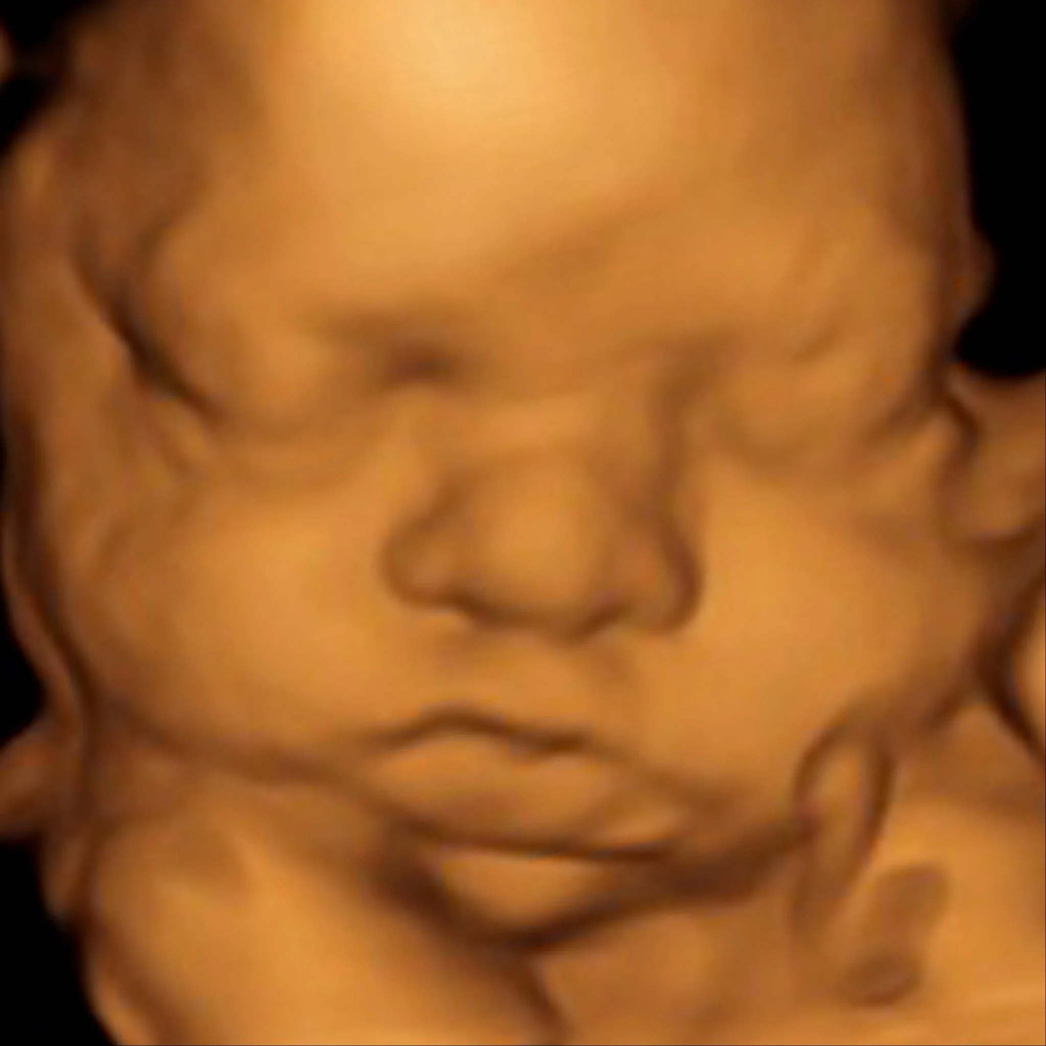 3D ultrasound image of a baby's face.