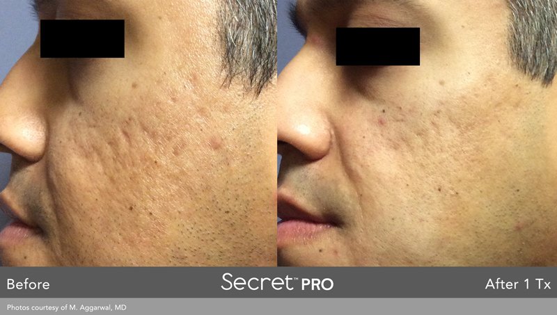 secretpro-before-after-4.jpg