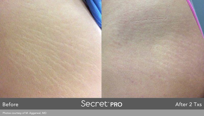 secretpro-before-after-6.jpg