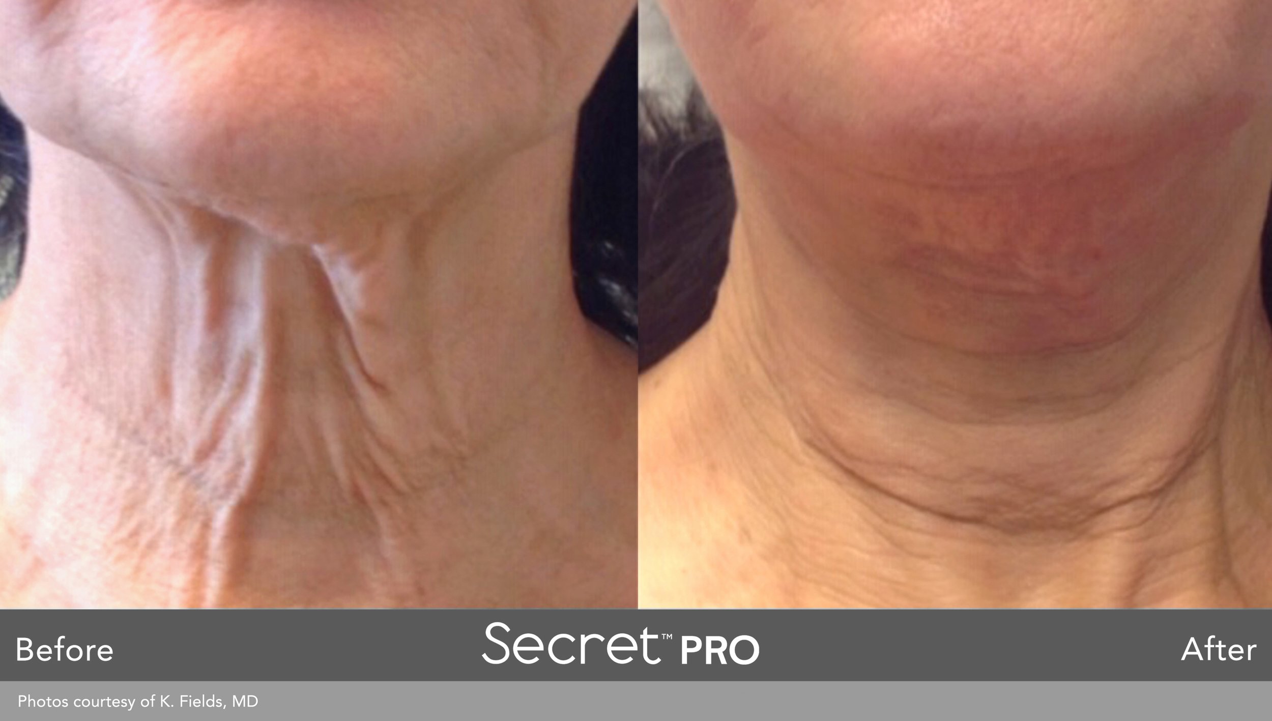 secretpro-before-after-8.jpg