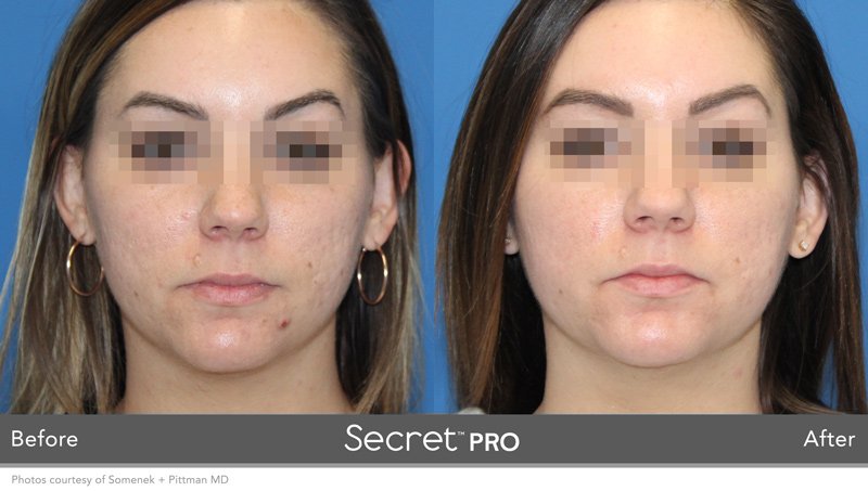 secretpro-before-after-11.jpg