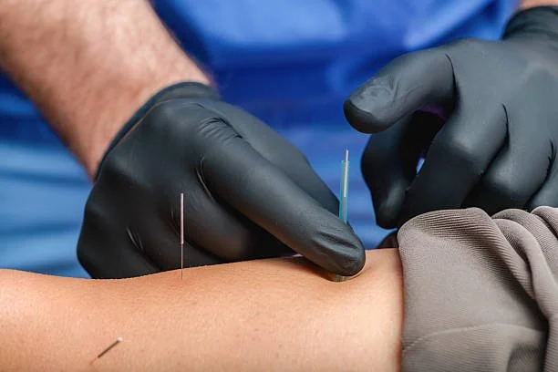 Dry Needling Image.jpg