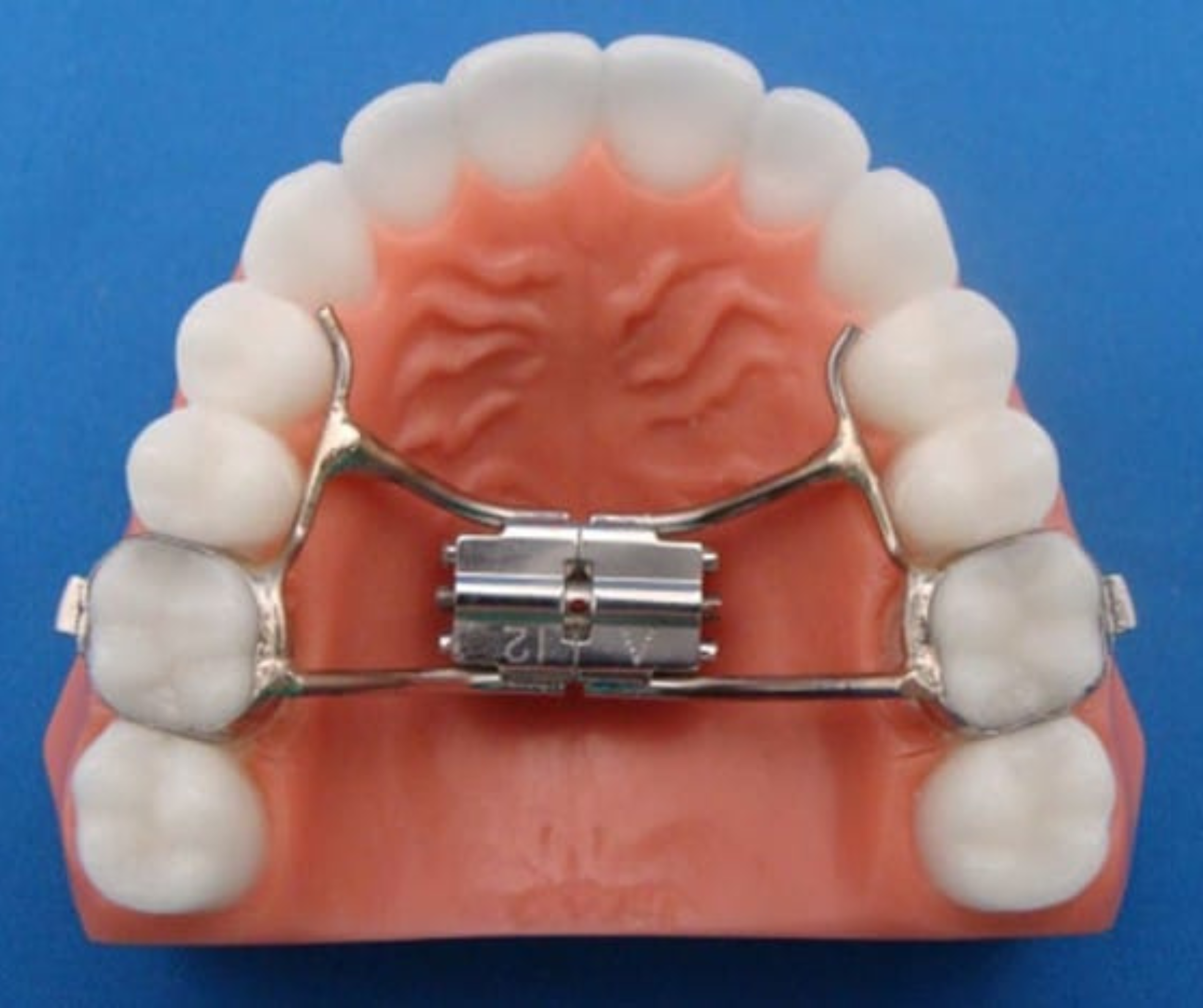 Palatal Expander Process