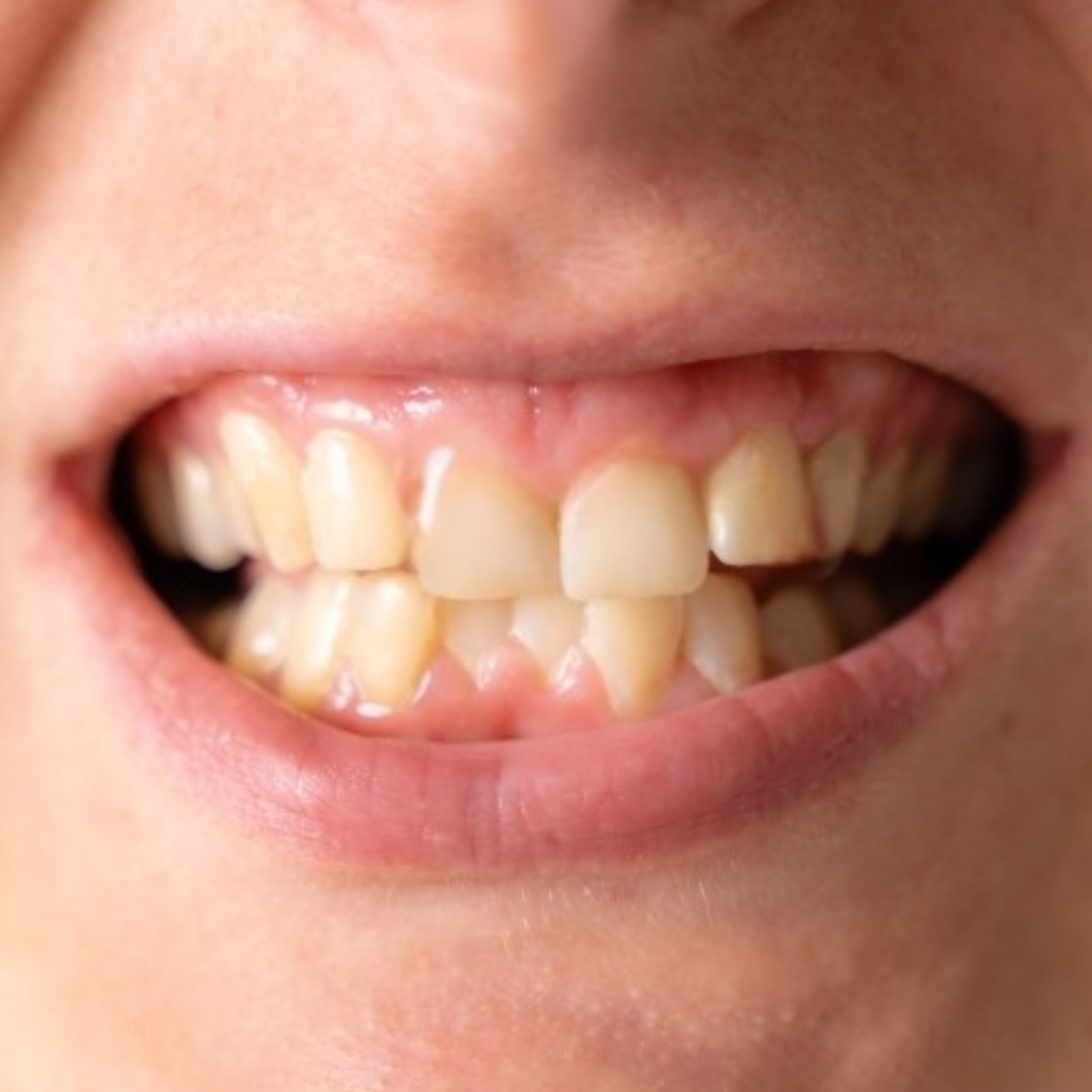 Children’s Dental Health Month: Why an Orthodontic Screening at Age 7 Matters