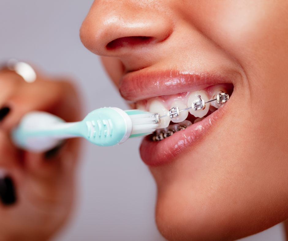 Maintaining Oral Hygiene with Braces or Aligners Essential Tips for a