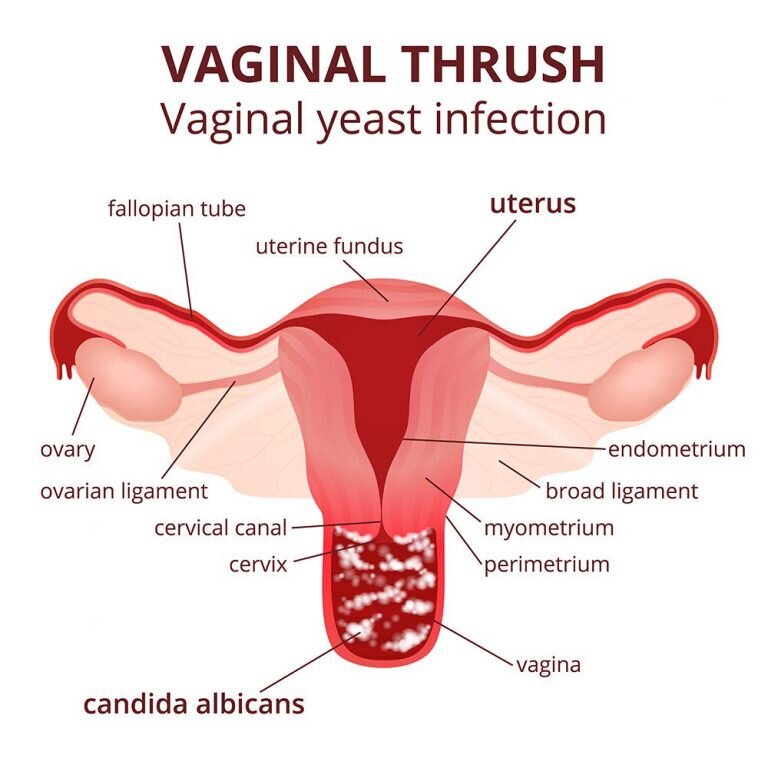 vaginal infection during pregnancy