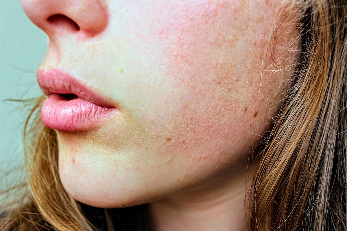 flov hvile Samle Your guide to rosacea & how to treat it — True Skin Cosmetic & Laser Clinic
