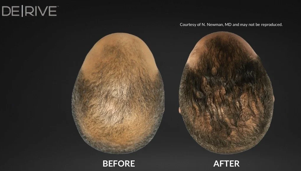 Comparison of a bald head before and after hair growth treatment, with the "before" showing a shaved or bald scalp and the "after" showing a scalp with dense, curly hair.