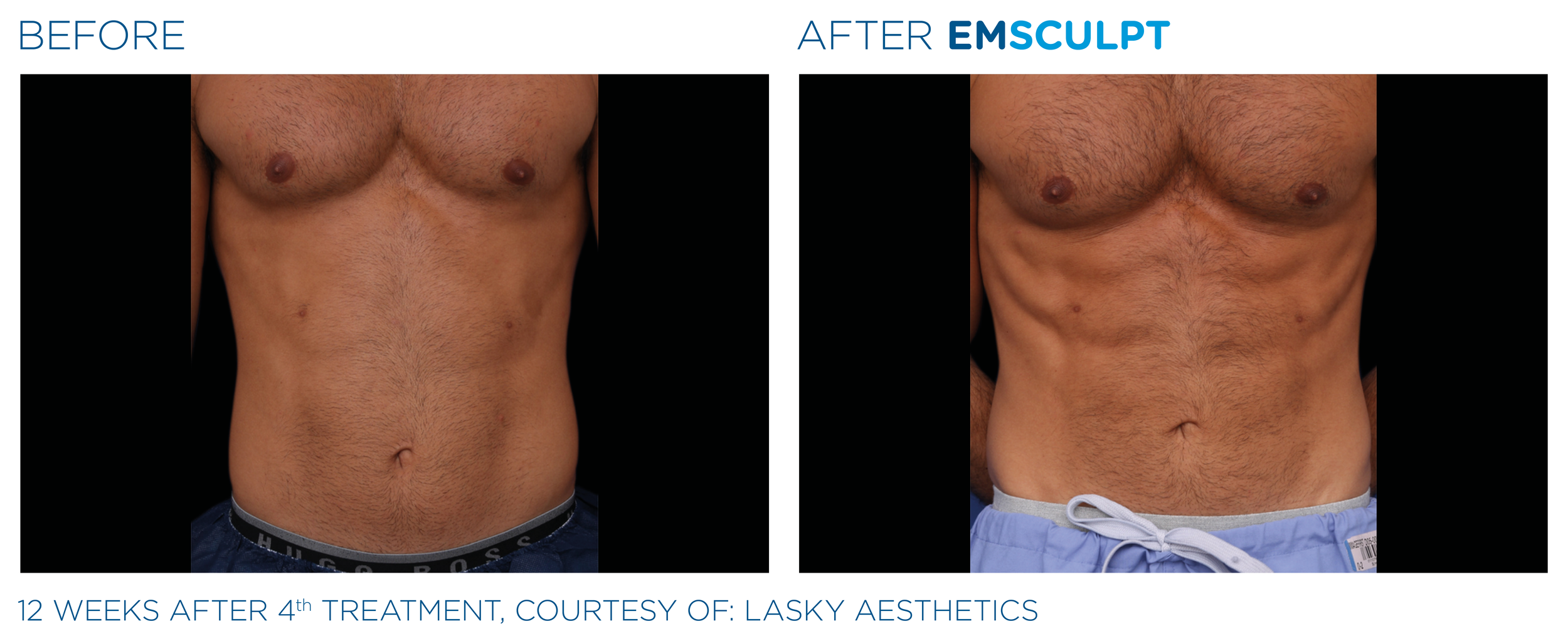 West Loop Emsculpt Neo