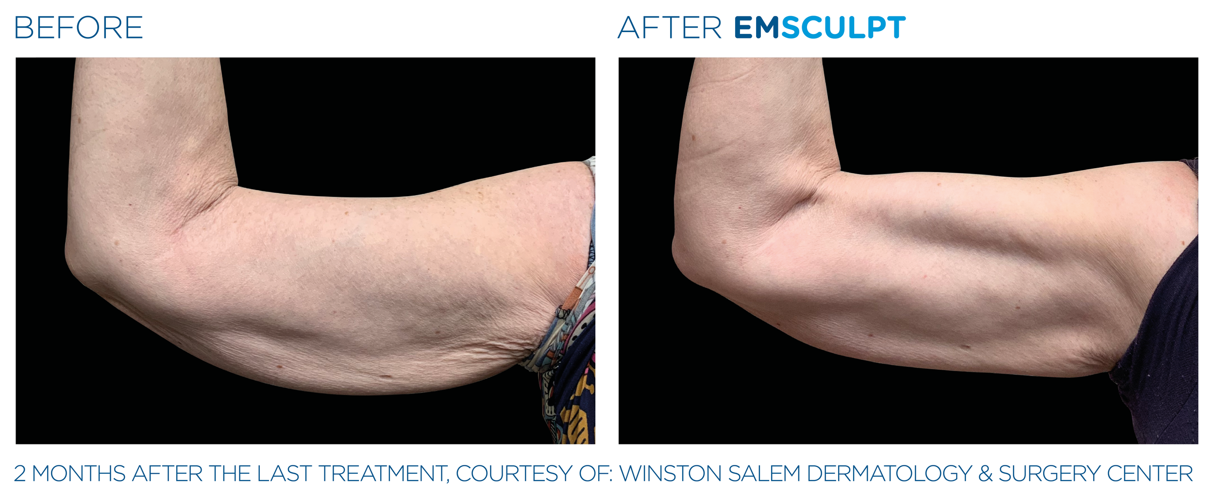 Emsculpt Neo Before and After