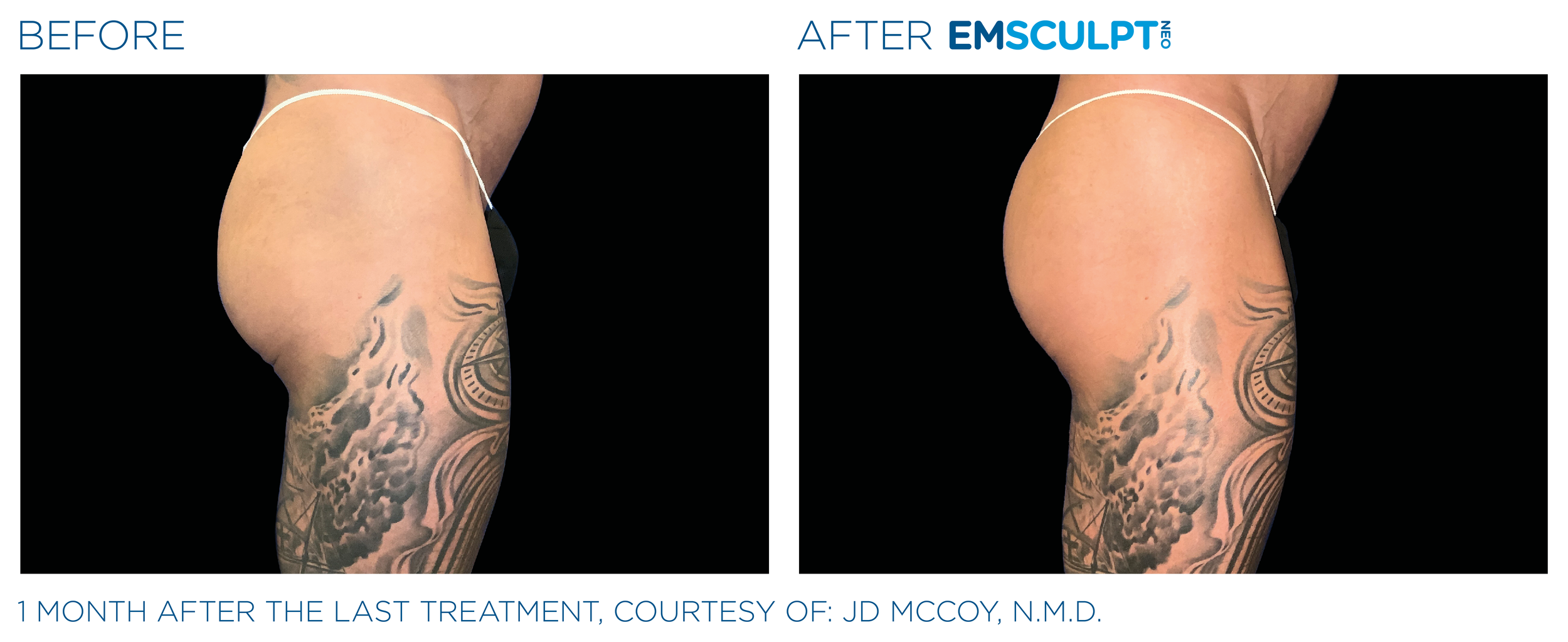 Before and After EmSculpt Chicago