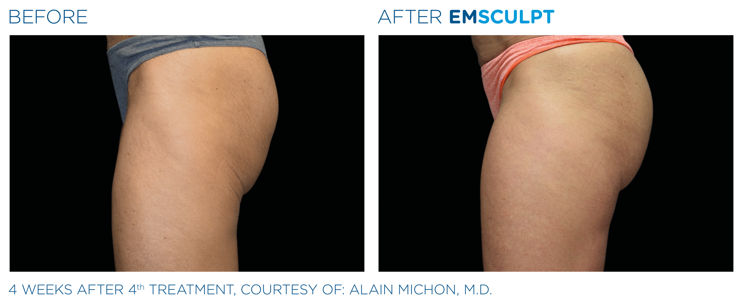 Emsculpt Neo Results