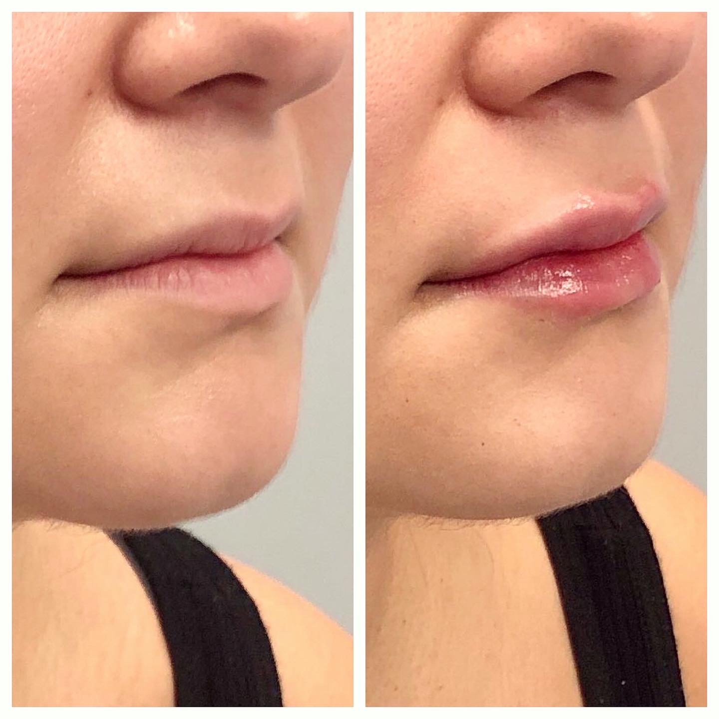 Best Dermal Fillers Chicago