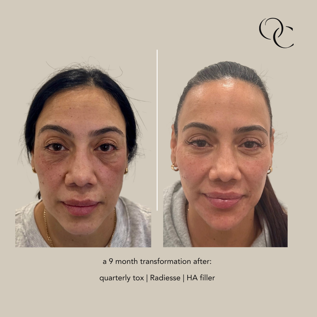 Side-by-side comparison of a woman before and after a 9-month transformation, showing improvements in skin appearance with treatments including quarterly toxin, Radiesse, and HA filler.