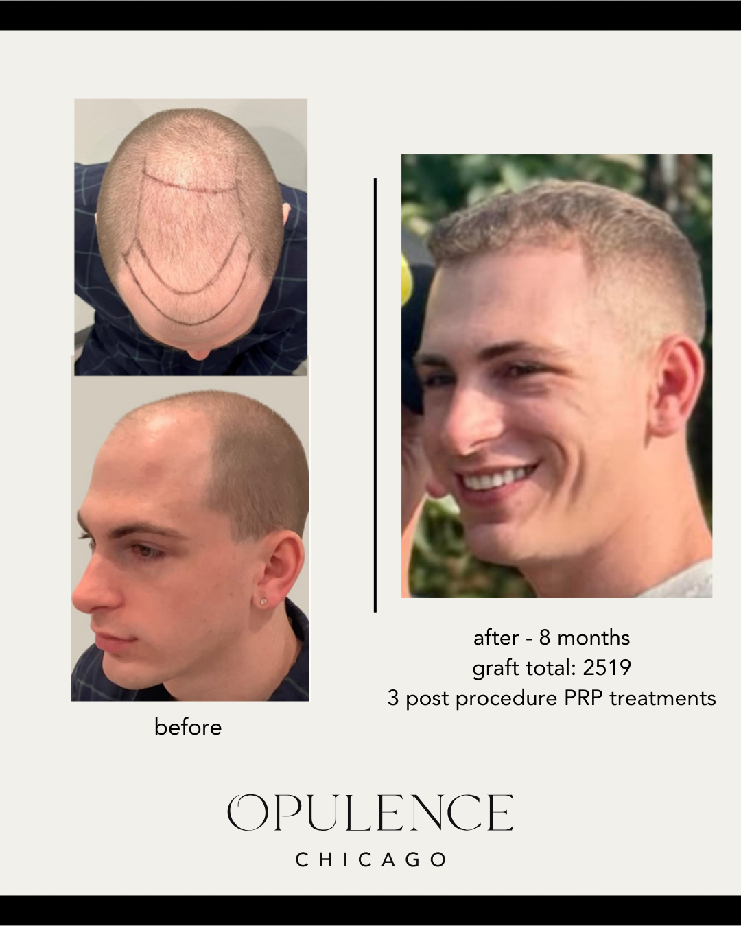 hair restoration 2500 grafts.png