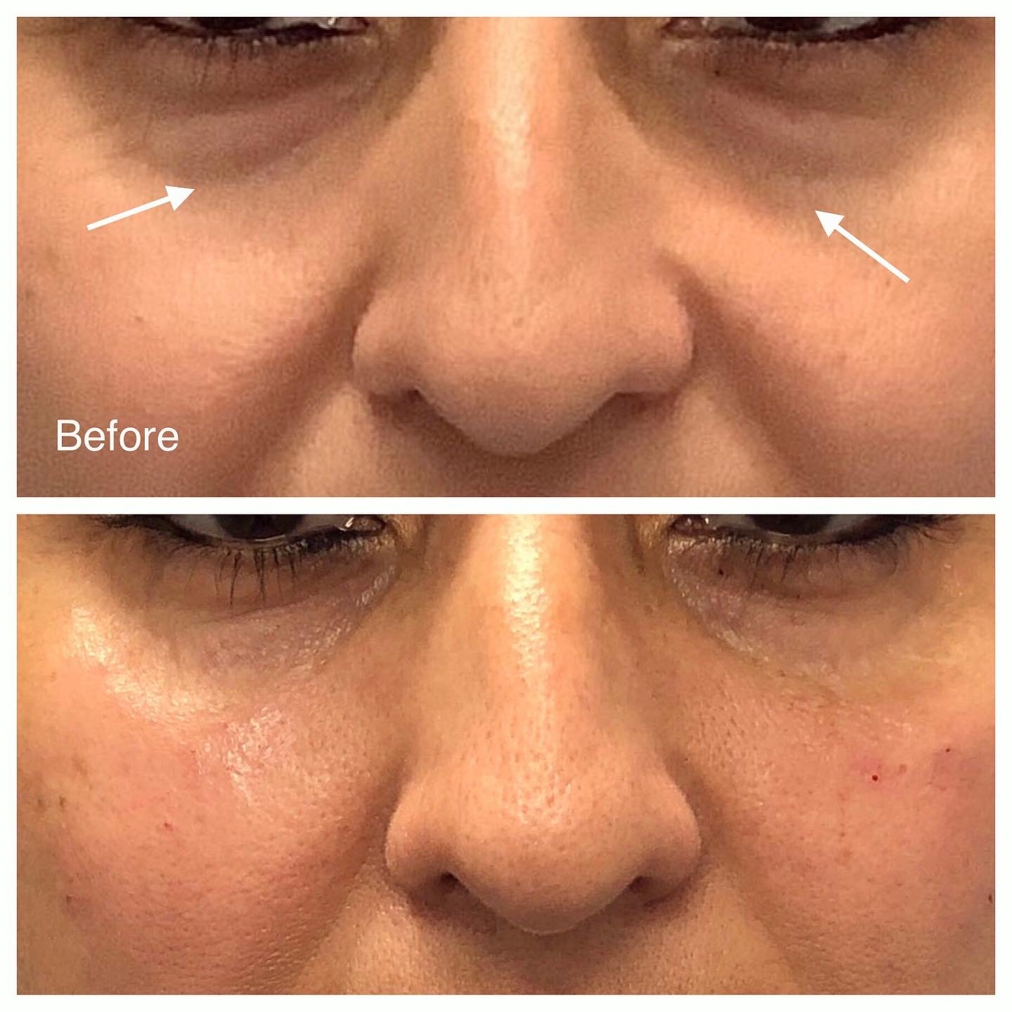 Chicago's Best Dermal Fillers