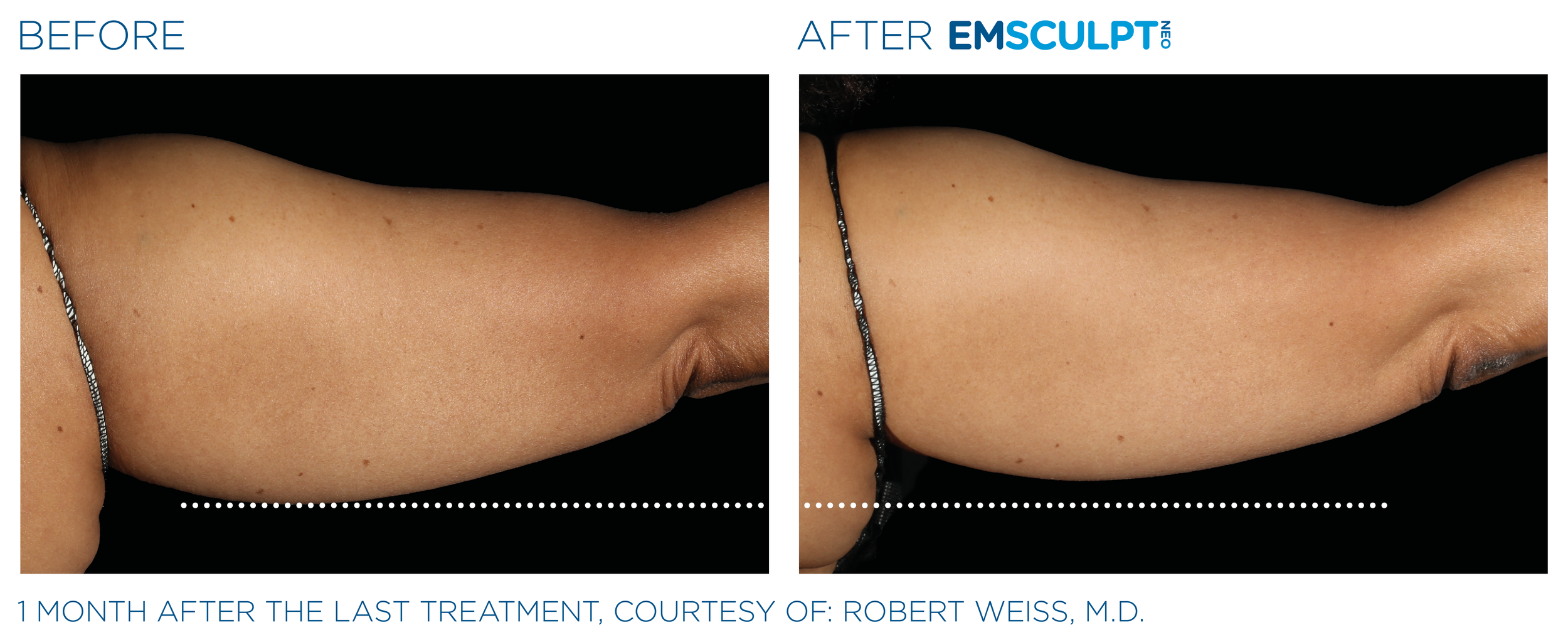 Best Rated Emsculpt Spa