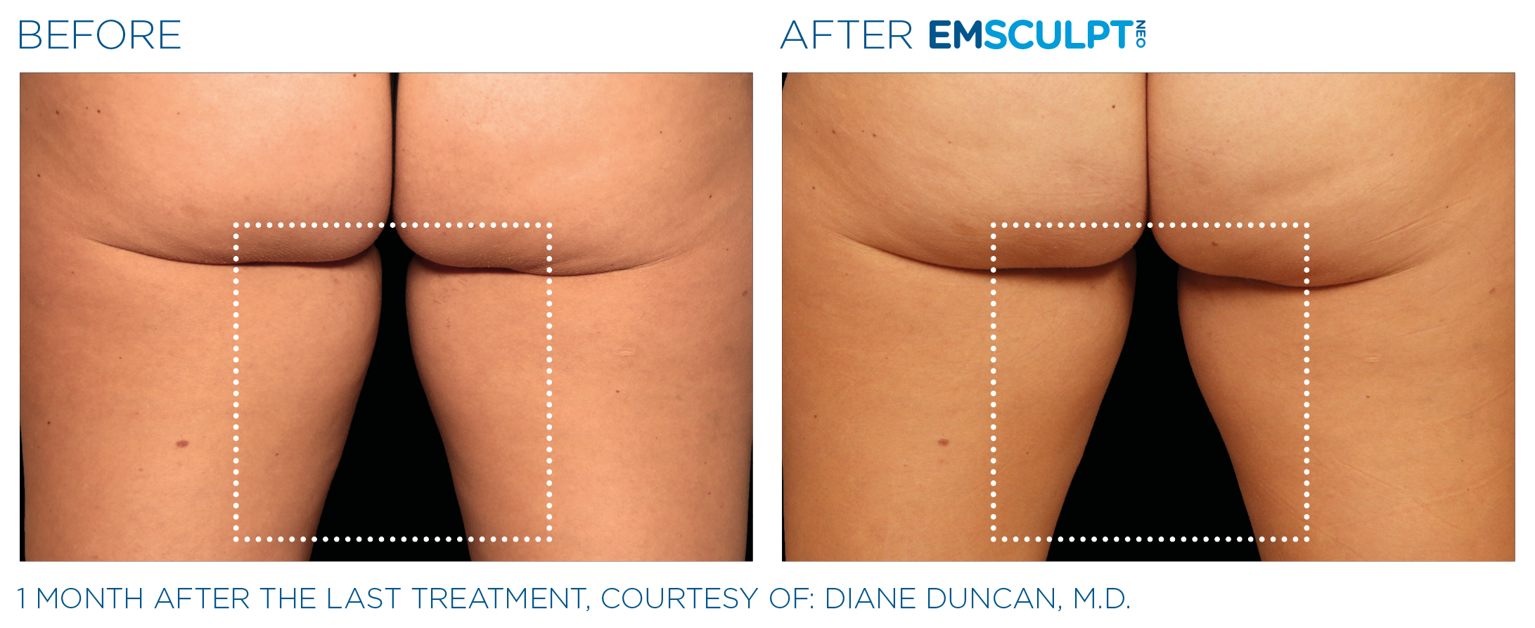 Where to Get EmSculpt Done At