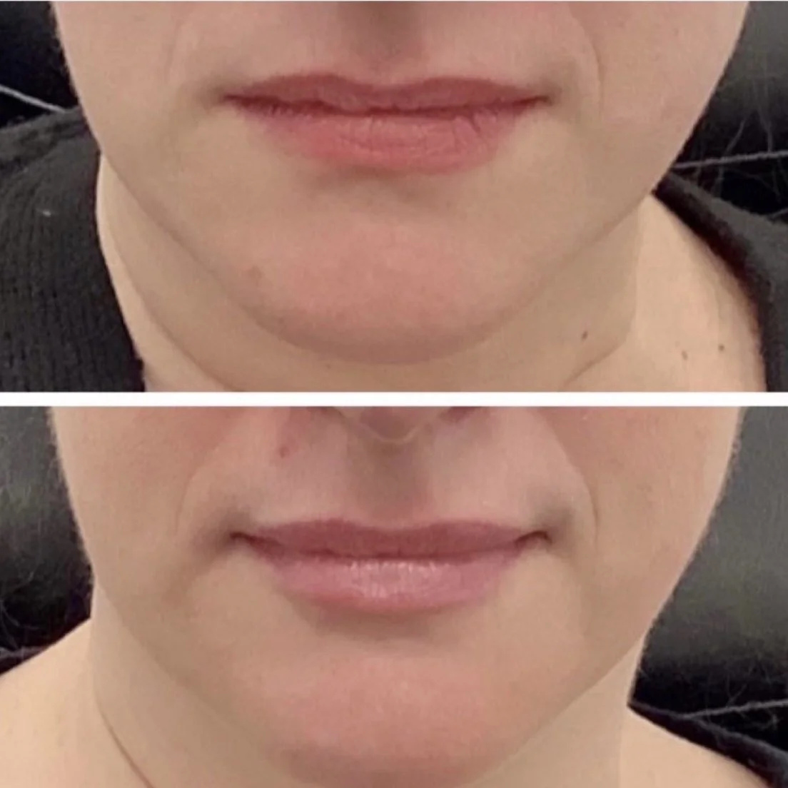 lip filler.jpg