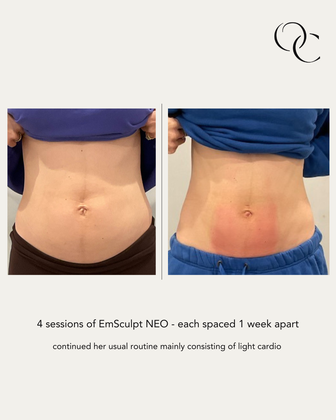 emsculpt neo abs west loop medspa.png