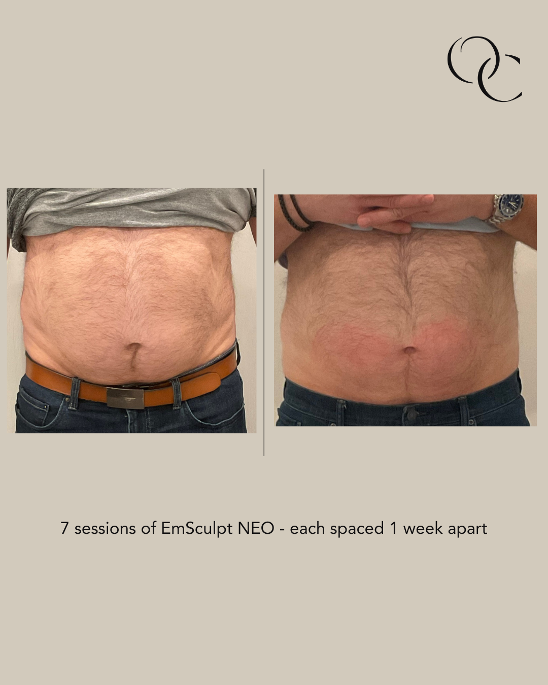 EmSculpt NEO before and after abs.png