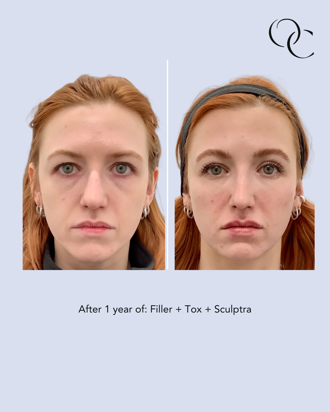 filler before and after chicago.png