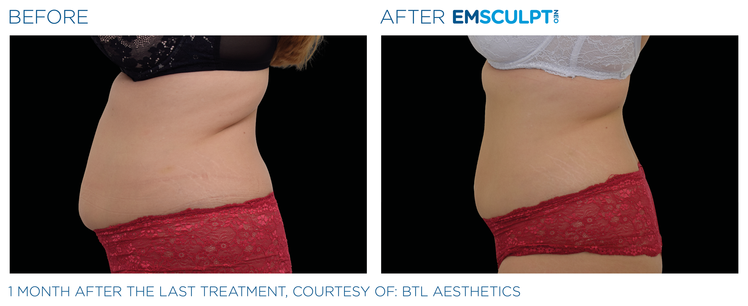Before and After EmSculpt Chicago