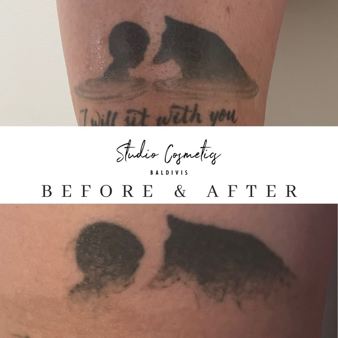 ✨ Tattoo Removal Tip! ✨
This picture was taken the day after the removal- colour will continue to break down over the next several weeks. Information on thick ink tattoos:

Got a tattoo with thick, bold ink? Don&rsquo;t worry &ndash; it can be remove