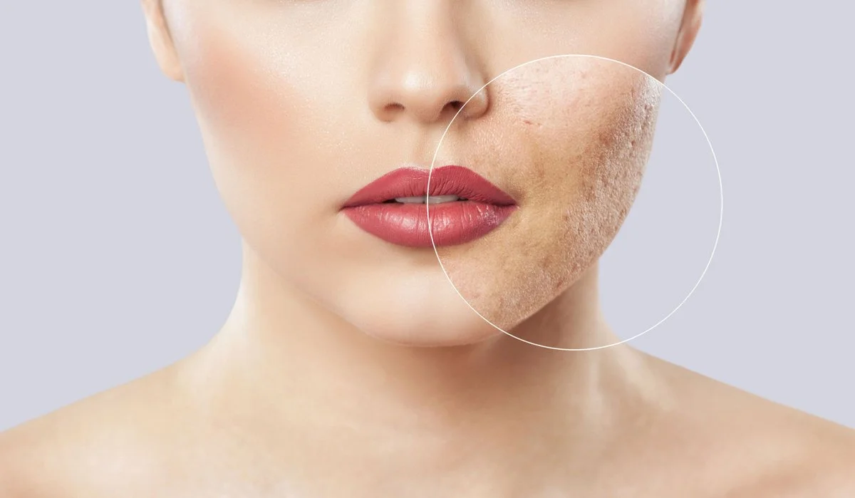 Acne Restorative Facial in Flagstaff, AZ: How to Remove Marks & Scars
