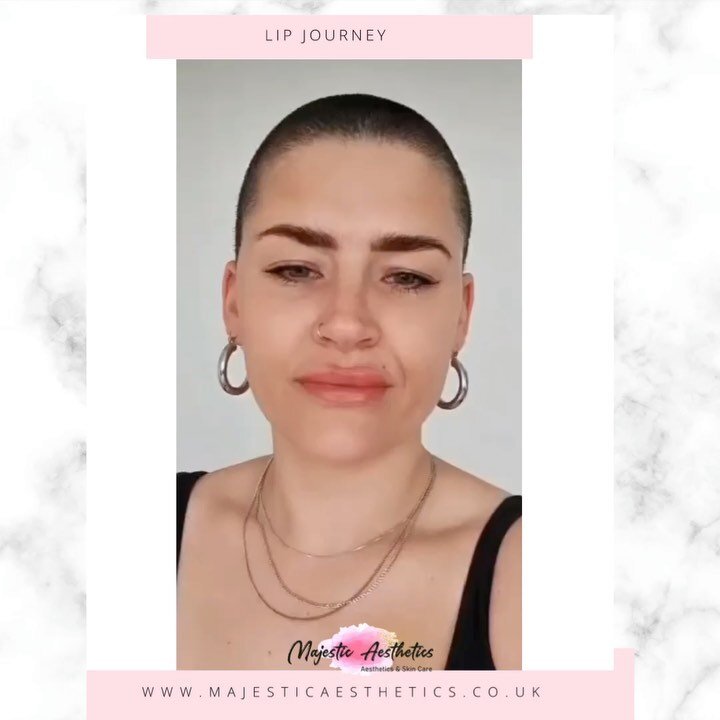 Day 3 post lip filler 👄

Has Kerry&rsquo;s journey helped you with worries post treatment? Let us know 😍

#aesthetics #cheekfillers #lipfillers  #esthetician #skincare #beauty #facials #aesthetic #esthetics #midwife #medical #professional #professi