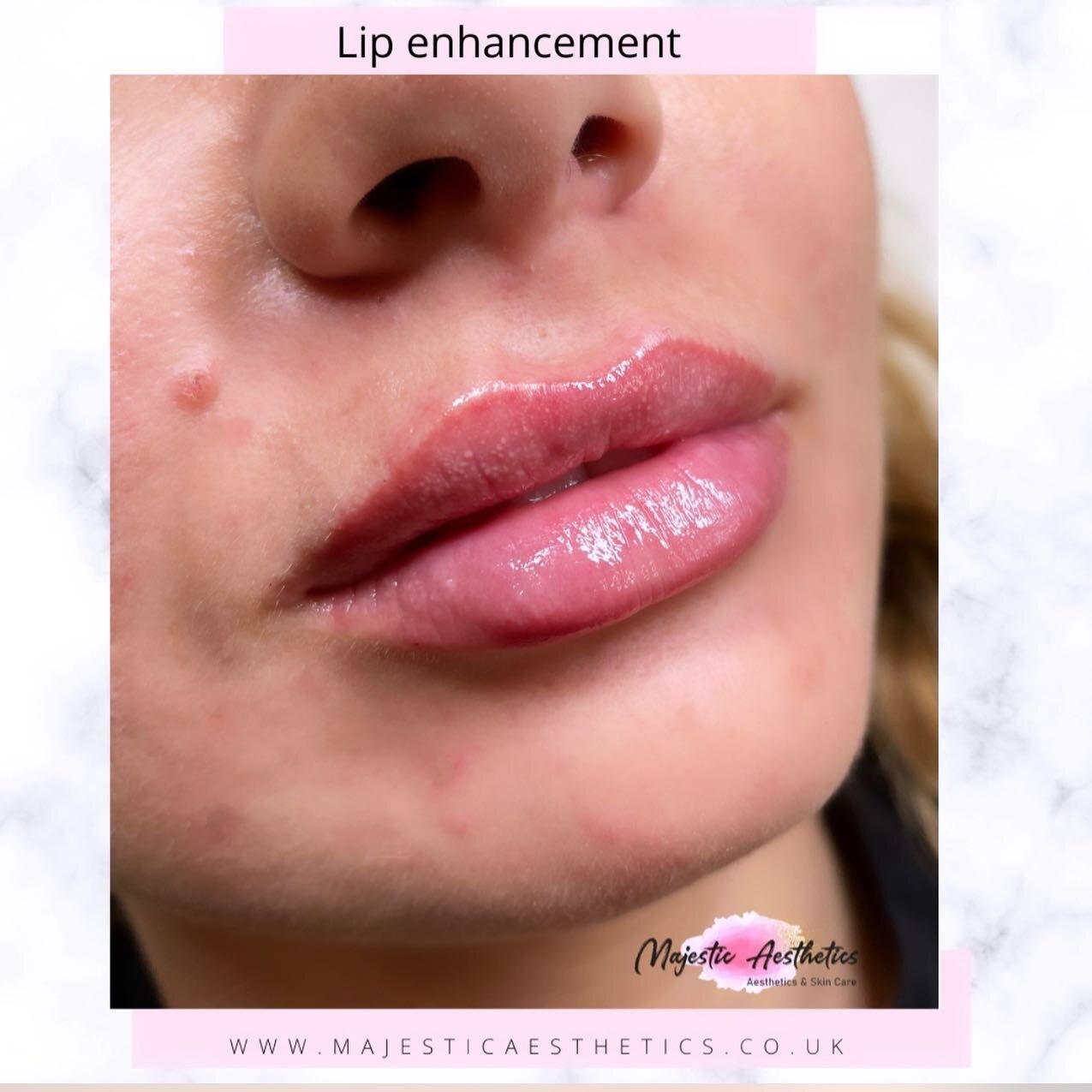 👄 Lip enhancement 👄

💉Topical numbing used prior to treatment.
💉Registered midwife / aesthetics practitioner.
💉Newly qualified nurse prescriber
💉Insured and regulated
📍Portsmouth

For all bookings; 
📩 info@majesticaesthetics.co.uk
Or DM 📱 @m