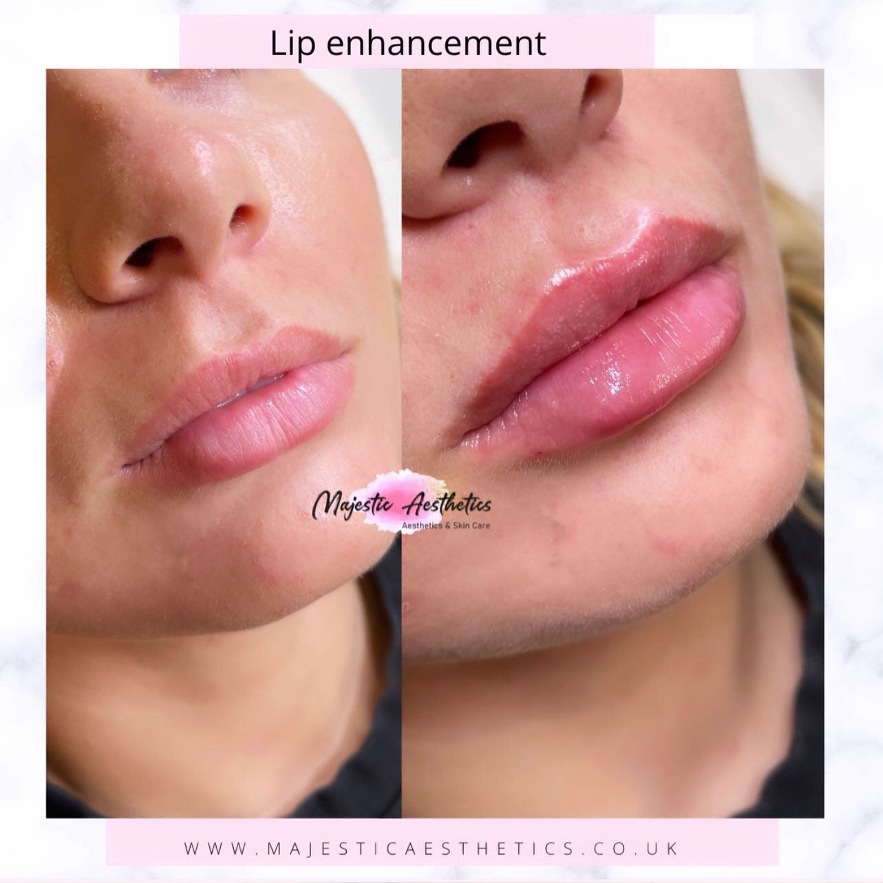 Same lips but different 👄 

How beautiful is this result 😍

Prices start from &pound;160 - for all bookings please contact @majestic_aesthetics_clinic 👄👄

#aesthetics #cheekfillers #lipfillers  #esthetician #skincare #beauty #facials #aesthetic #