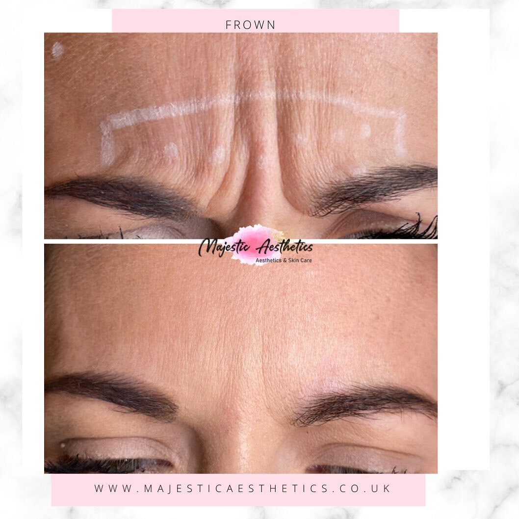 Improving the frown can make such a difference 💉😍

Static lines are lines you may develop over time and these can be harder to target after the first treatment. Static basically means the line is still visible when the muscles aren&rsquo;t moving (