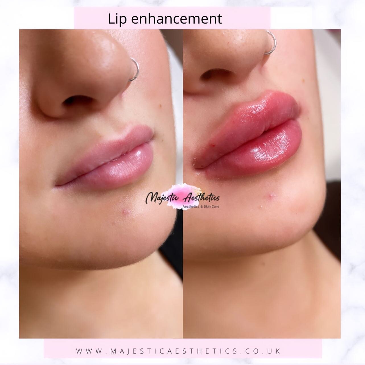 1ml 💉
Swelling can be see especially to the top lip post treatment however this will resolve within 48-72 hours 👄 

Size will reduce once dermal filler has settled in to surrounding lip tissue.

1ml - &pound;220 👄
Topical numbing cream used 👩🏼&z