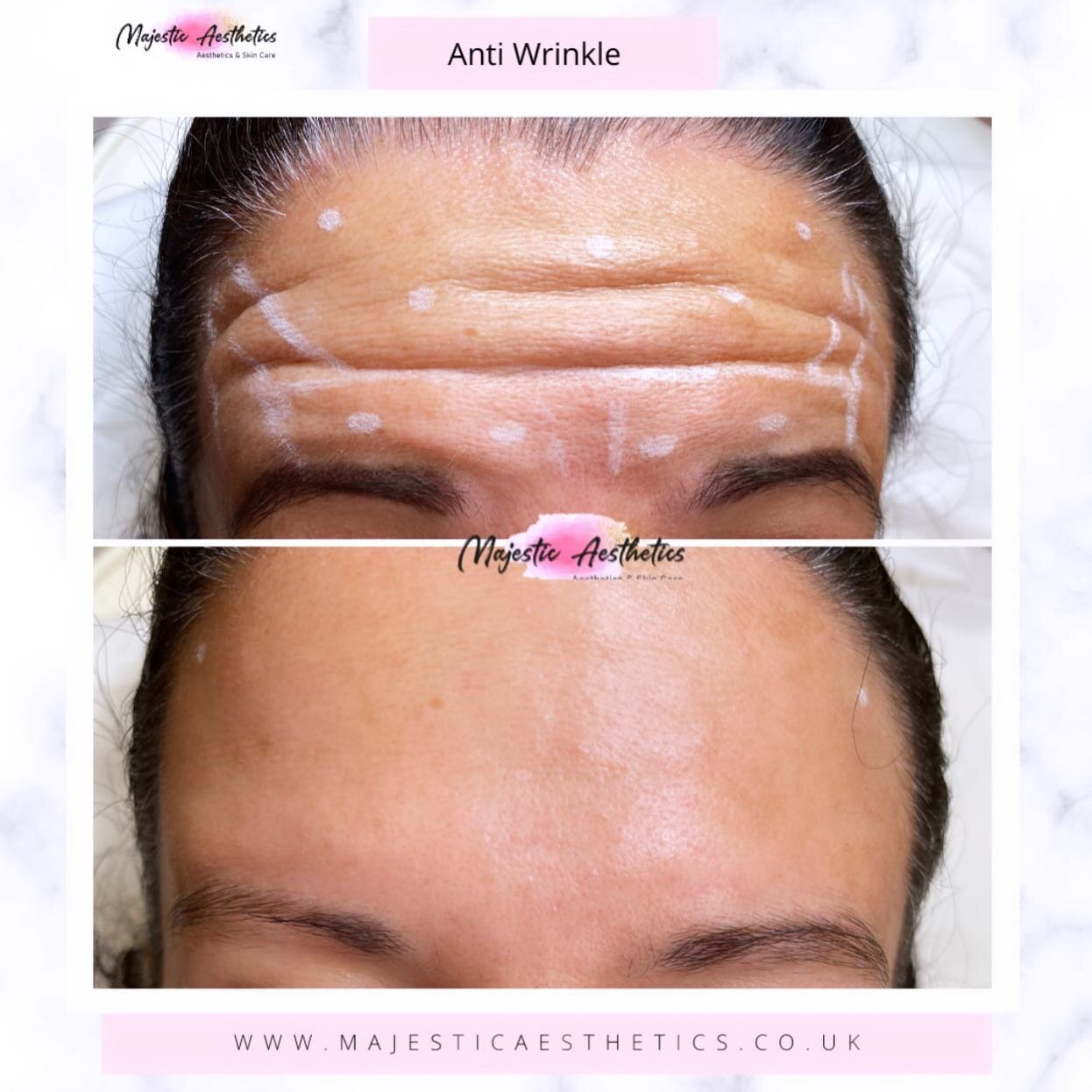 Results never lie 🤫 

Forehead and frown anti wrinkle treatment.. two weeks between. All anti wrinkle treatments come with a two week review due to the nature of the treatment and the occasional need for adjustment doses.

Bookings page: Beth @majes