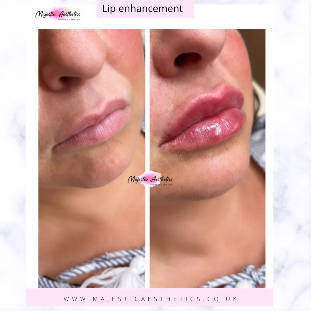 Lip enhancement 👄  1ml @stylage
Pre numb 💠
Treatment time: 10-15mins ⏰ 

Tenting / Russian 👄 

Bookings @majestic_aesthetics_clinic

Aesthetics practitioner Kate @majestic_aesthetics 

#russianlips #tenting #lipresults #lipenhancement #beforeandaf