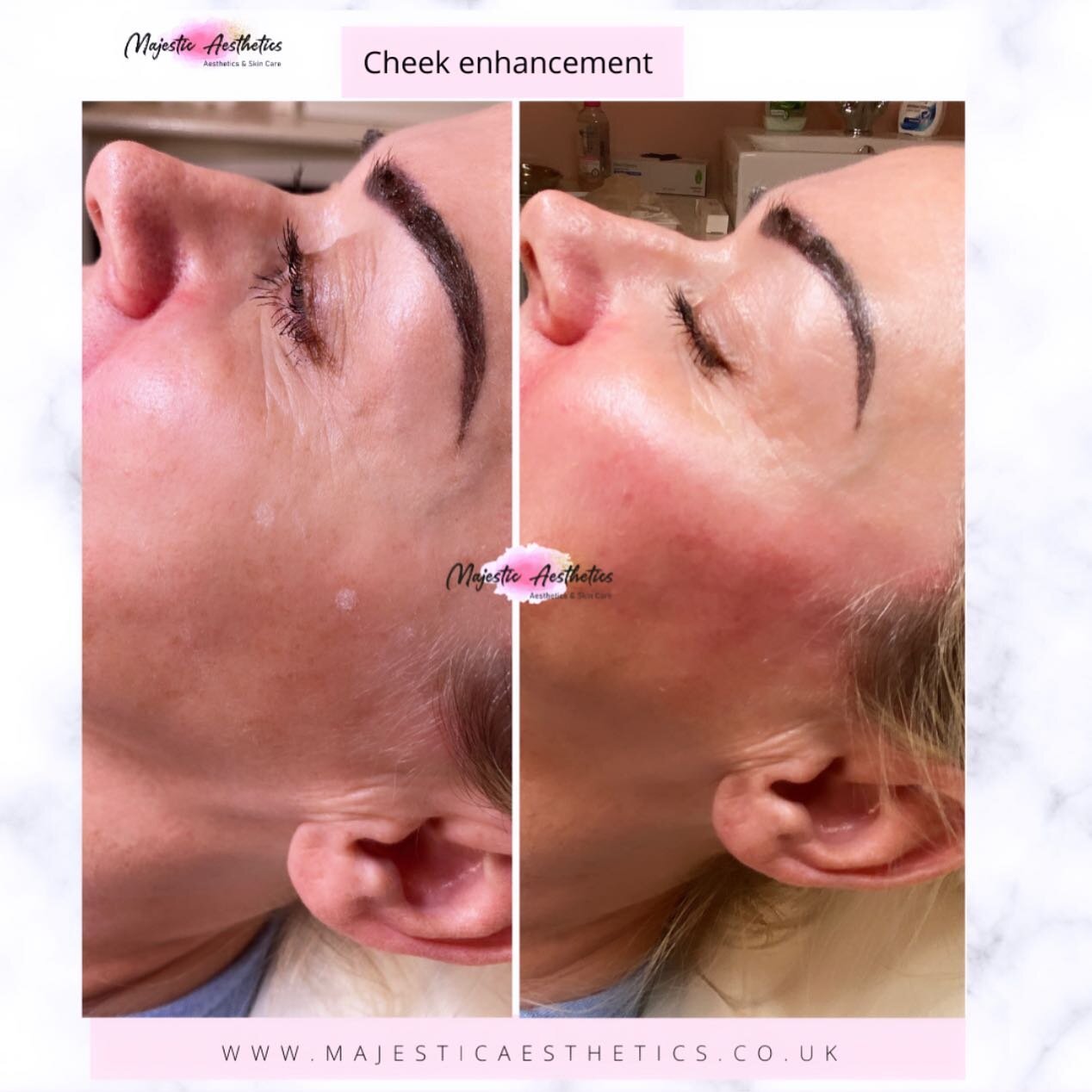 Cheek enhancement 💉

This treatment Contours the cheek and adds volume to create a subtle yet stunning result. It helps (gently) lift the lower face and creates a beautiful enhancement that can restore the mid face.

2ml total 💉

@majestic_aestheti