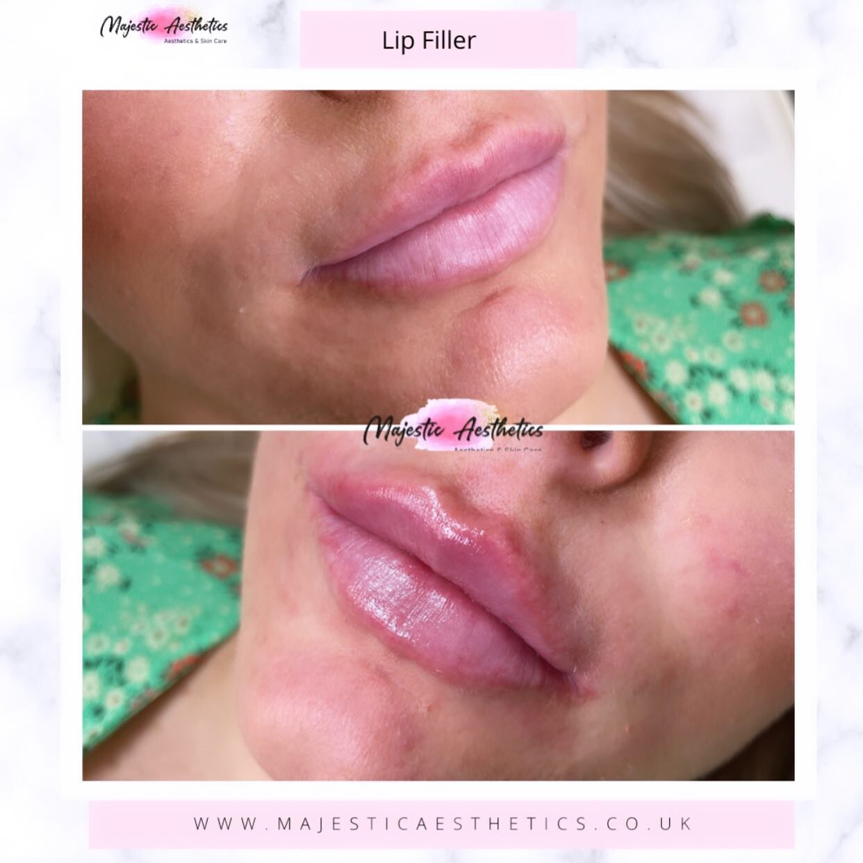 Not all enhancements have to be extra.

👄 👄👄👄👄👄👄👄👄👄👄👄

@majestic_aesthetics

#aesthetics #cheekfillers #lipfillers  #lipenhancement #esthetician #skincare #beauty #facials #aesthetic #esthetics #midwife #medical #professional #professiona