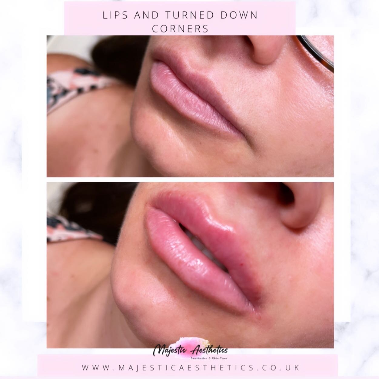 Lifting, hydrating, and shaping 👄 

This beauty lives in surrey so it&rsquo;s always such a privilege to see her 😍

Beautiful result for a beautiful lady.

@majestic_aesthetics

#aesthetics #cheekfillers #lipfillers  #esthetician #skincare #beauty 